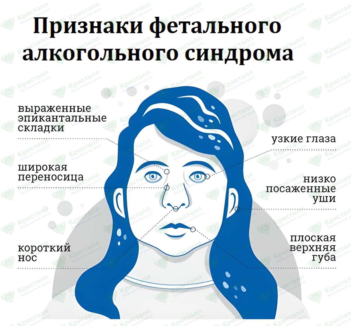 Инфографика признаки фетального синдрома